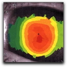 Opération hypermétropie laser